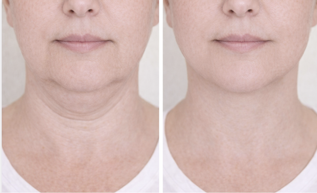 Before and after body sculpting results showing a more defined jawline and toned waistline
